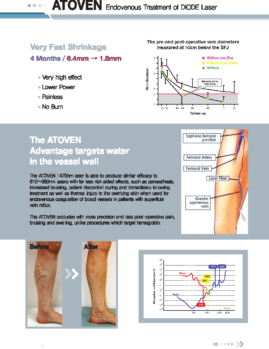 laser varicose vein varises Diotech