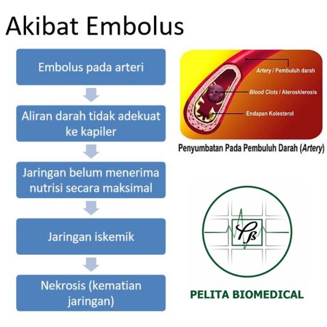 Akibat Embolus